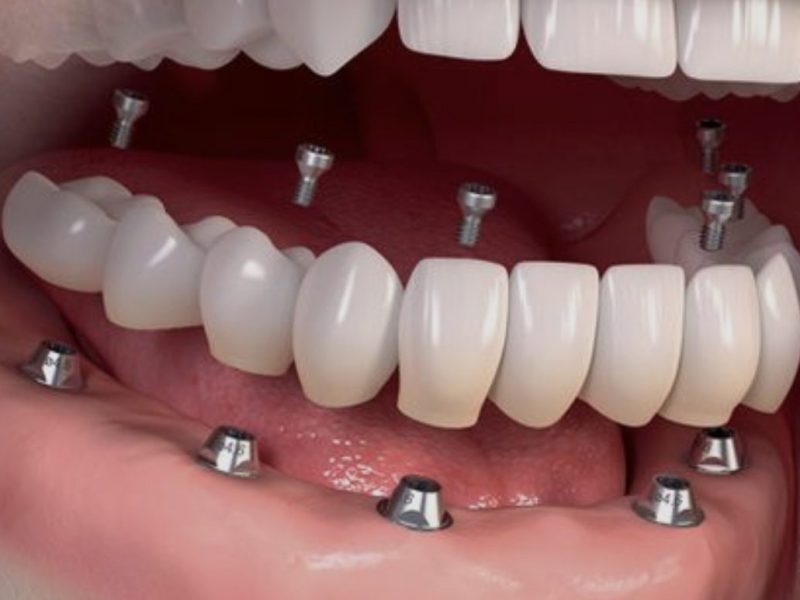 implantes dentales protesis completa sobreimplante