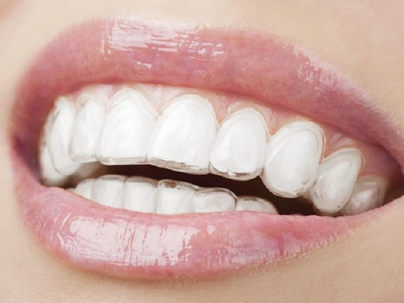 ortodoncia invisible invisalign dentista tona