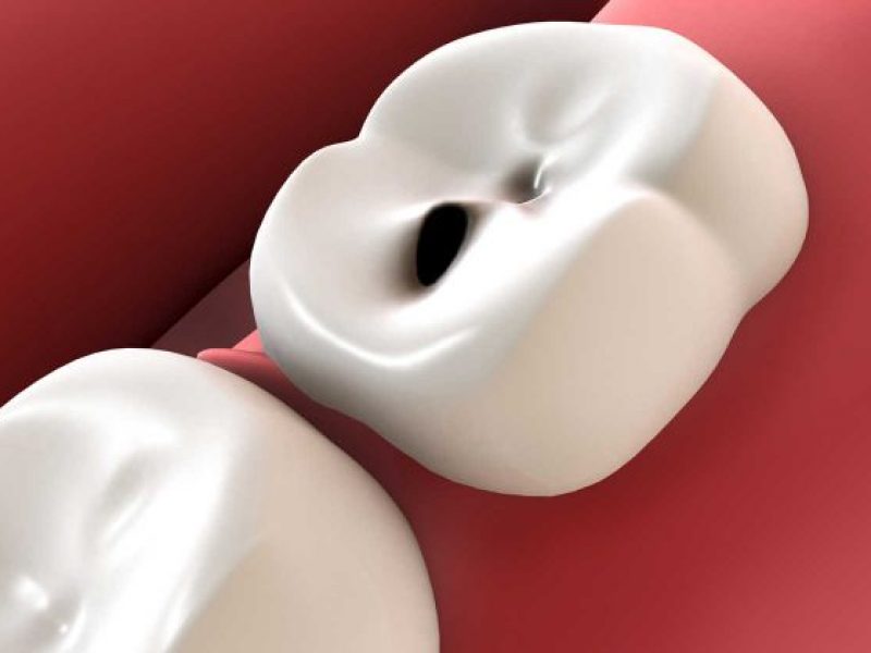 caries dental restauracion endodoncia