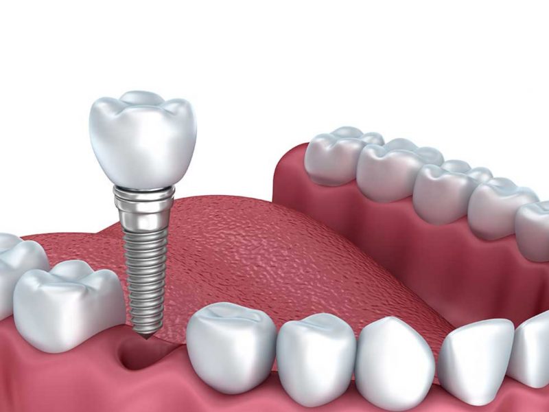 implante dental unitario pieza perdida