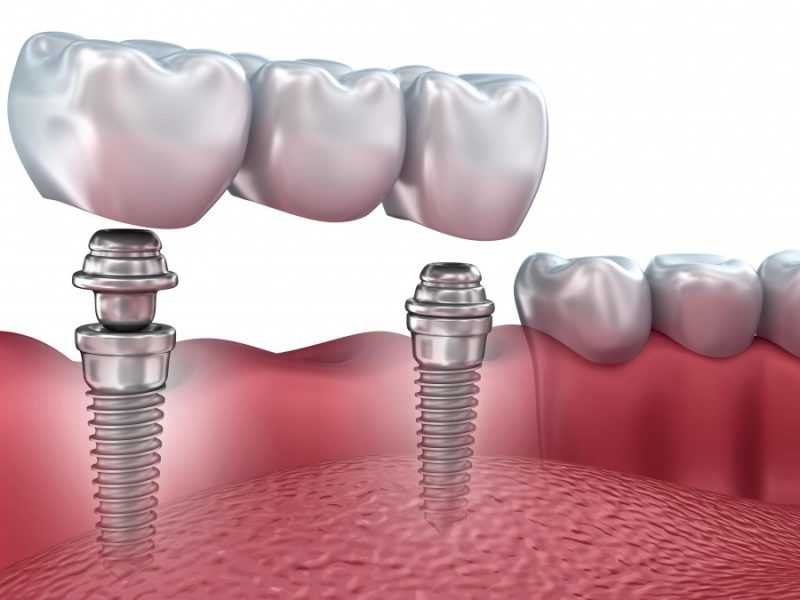 implantes dentales puente ceramico
