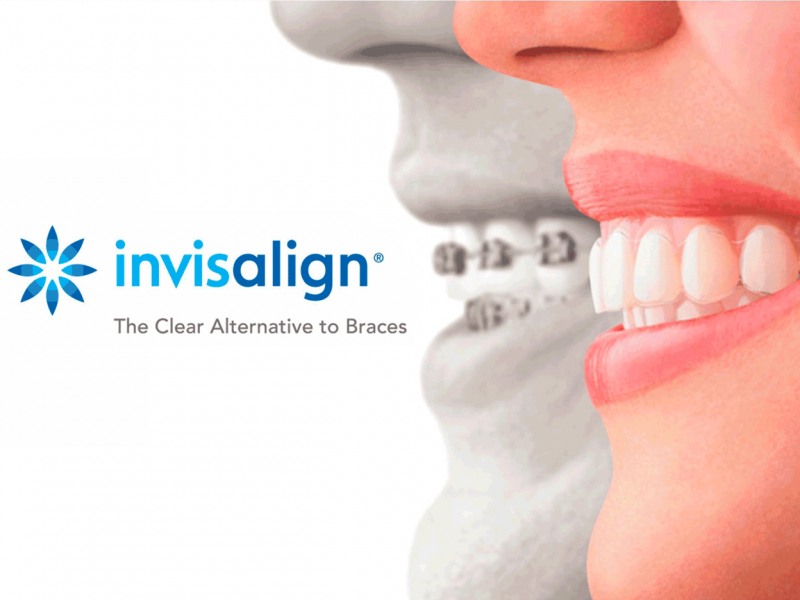 tratamiento ortodoncia invisible invisalign dentista tona