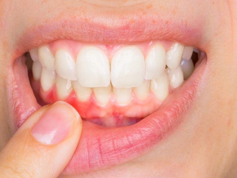 encias hinchadas inflamadas periodoncia