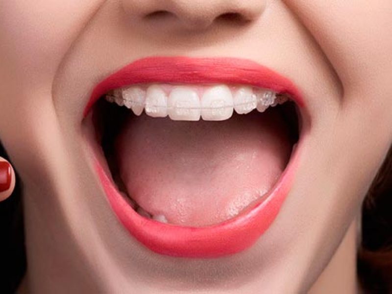 ortodoncia estetica invisible zafiro dentista