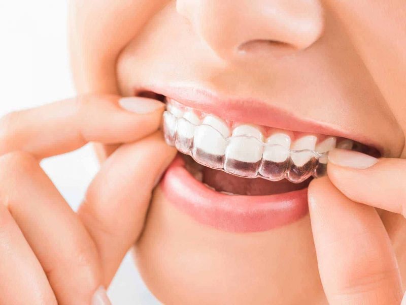 tratamiento ortodoncia invisible invisalign